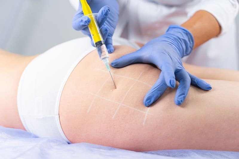 Carboxiterapia Corporal