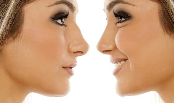 Nariz o Rinoplastia