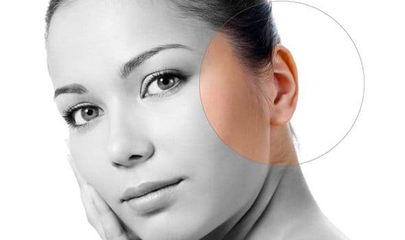Orejas u Otoplastia